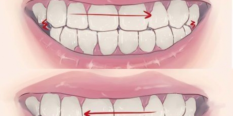 Smetti di digrignare i denti nel sonno
