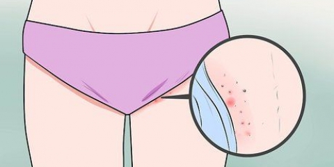 Riconoscere i sintomi del cancro alle labbra