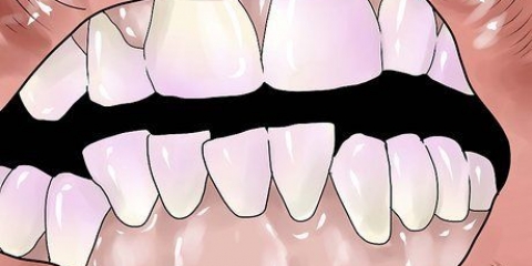 Rimuovere la placca dentale