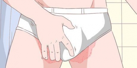 Trattare tinea cruris con sudcrem