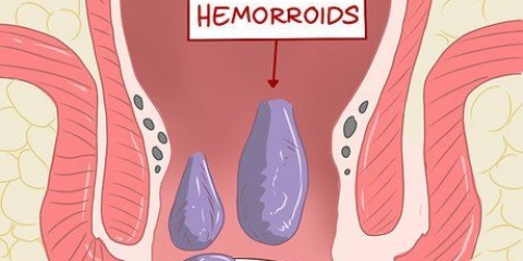 Usando l'amamelide per curare le emorroidi