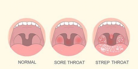 Scoprire se hai un'infezione da streptococco