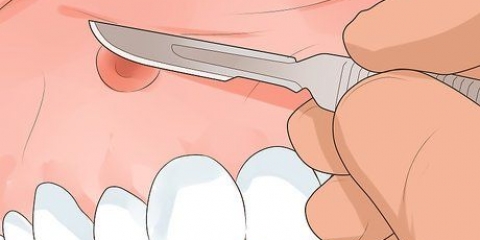 Come sbarazzarsi di un ascesso gengivale