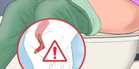 Determinare se soffri di emorroidi interne