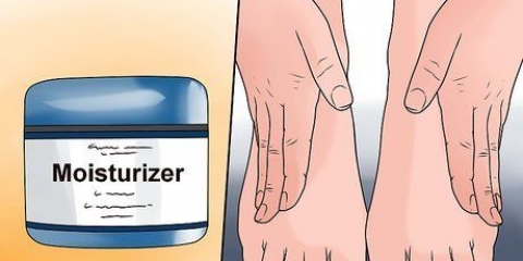 Trattare l'eczema invernale