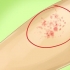 Riconoscere il morbillo