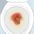 Riconoscere i sintomi del cancro al colon