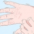 Trattamento dell'eczema alle mani
