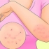 Trattare la scabbia