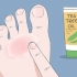 Curare l'eczema del nuotatore: si può fare naturalmente?